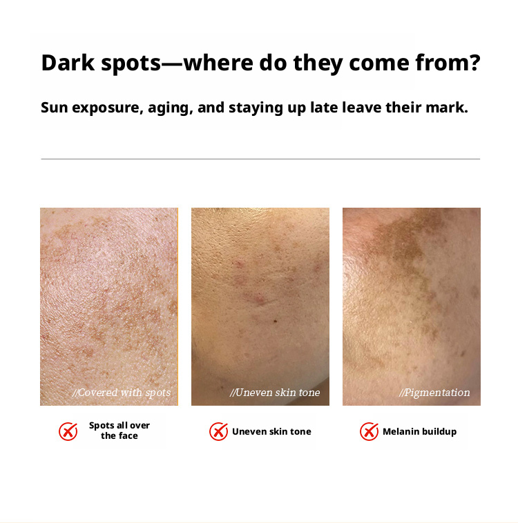 runchengyuan premium freckleremoval & sunscreen set runchengyuan premium freckleremoval & sunscreen set